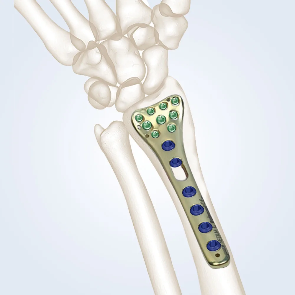 صفيحة كعبرة بعيدة راحية R-Anatomik
