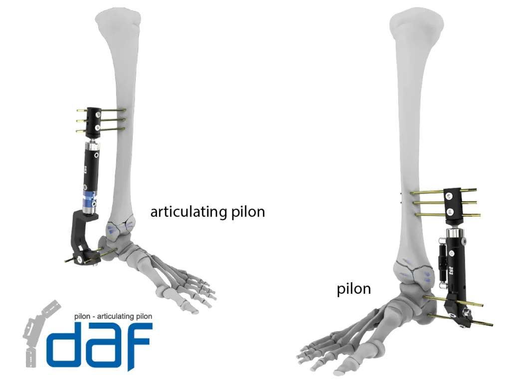 مثبت Pilon-Artikuler Pilon