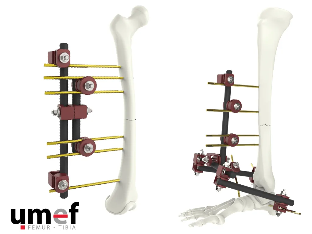 مثبت عظمة الفخذ والظنبوب UMEF Rod-Pin