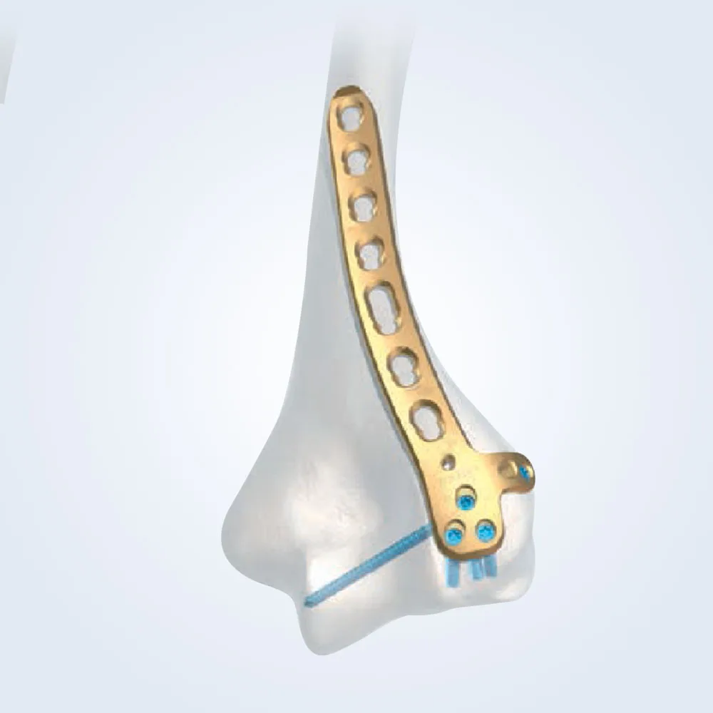 صفيحة عظمية للعضد البعيد Lateral Destekli Distal Humerus Dorsolateral