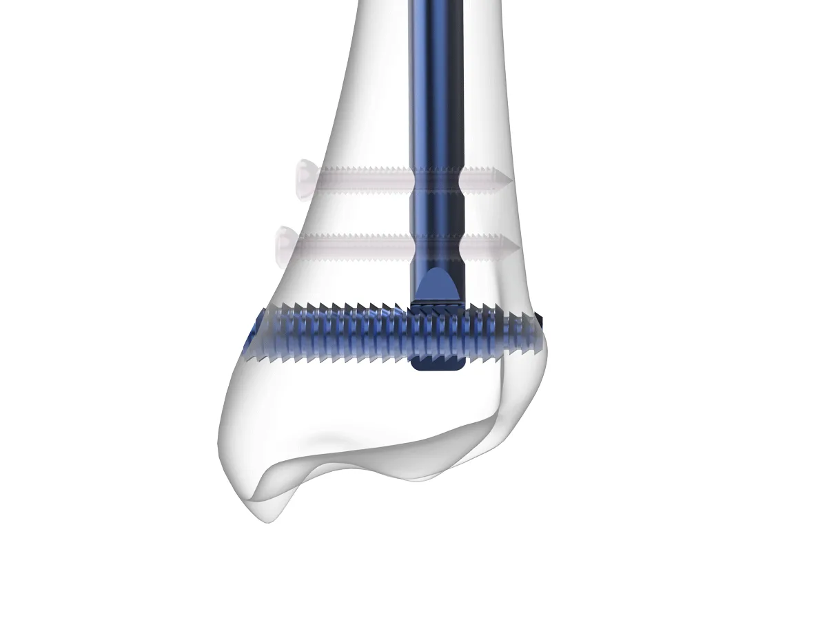 مسمار نخاعي للظنبوب TibiA DSBLS